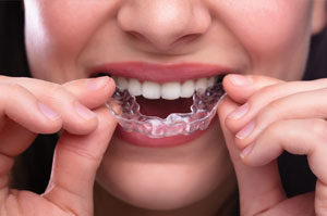Lady inserting a clear aligner.